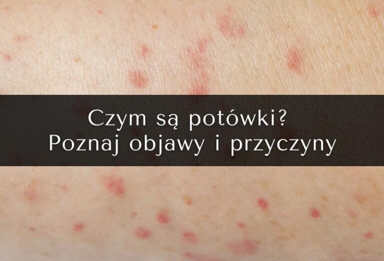 Potówki czy alergia u niemowlaka – jak rozpoznać, co naprawdę dolega twojemu dziecku?