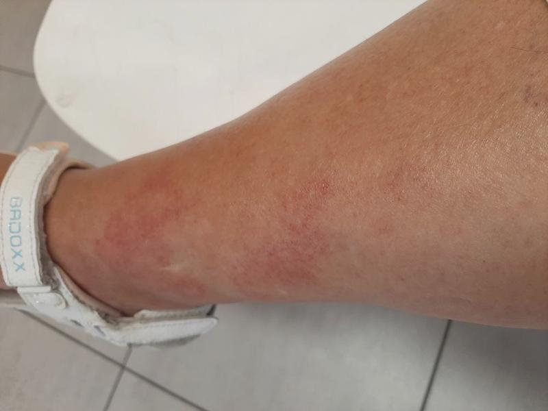 Bezpieczeństwo enoksaparyny