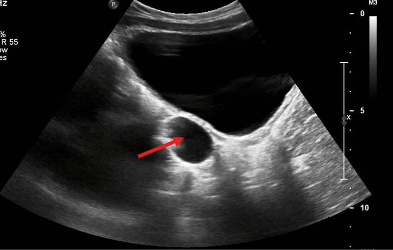 Diagnostyka torbieli jajnika