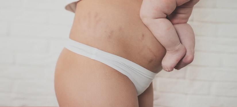 Diastaza po porodzie