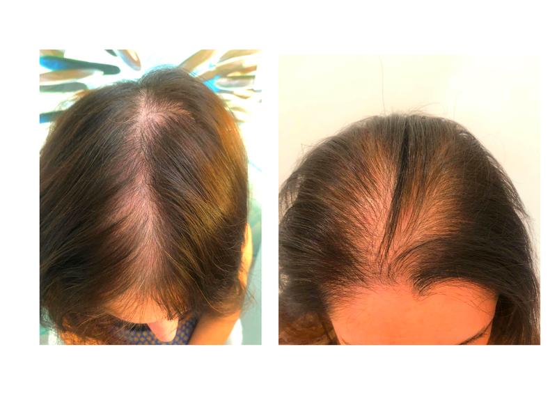 Dieta a wypadanie włosów