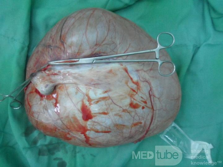 Objawy torbieli jajnika