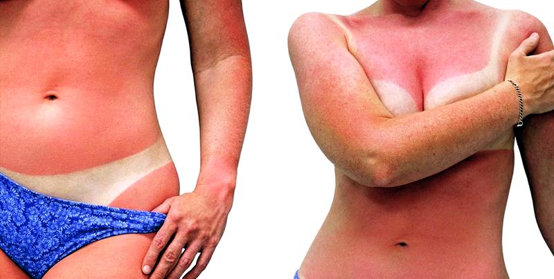 Oporzenia słoneczne u dzieci