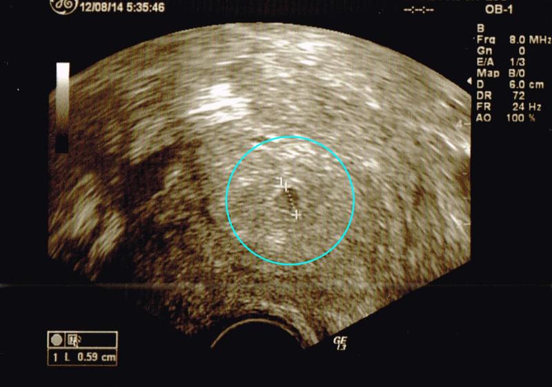 Przyczyny plamienia w ciąży