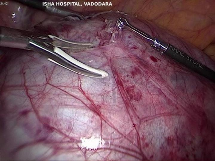 Torbiele jajnika w ciąży