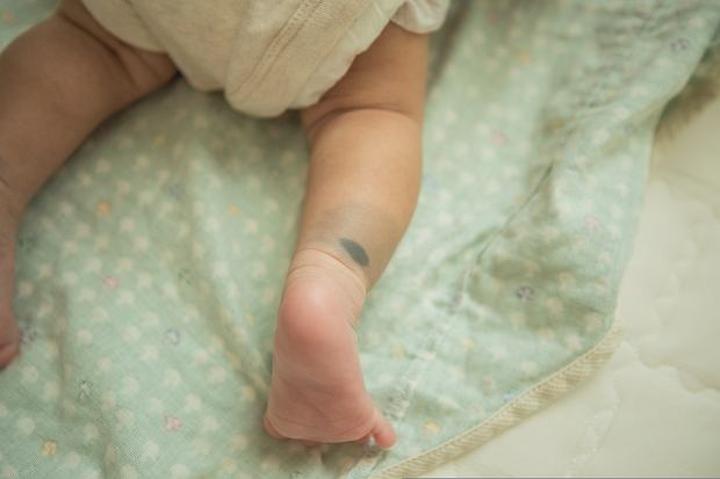 Dlaczego u noworodka mogą pojawić się siniaki po porodzie?