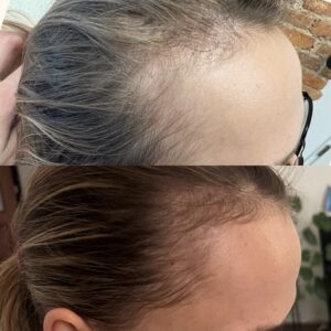 Ile czasu trwa wypadanie włosów po porodzie? Oto, co musisz wiedzieć