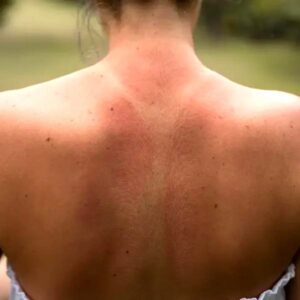 Jak skutecznie leczyć oparzenia słoneczne u dzieci? Praktyczne porady dla rodziców