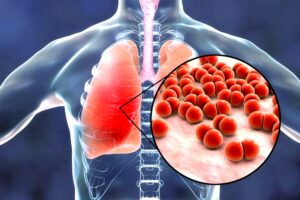 Skuteczne metody leczenia zapalenia płuc u dzieci – co warto wiedzieć?