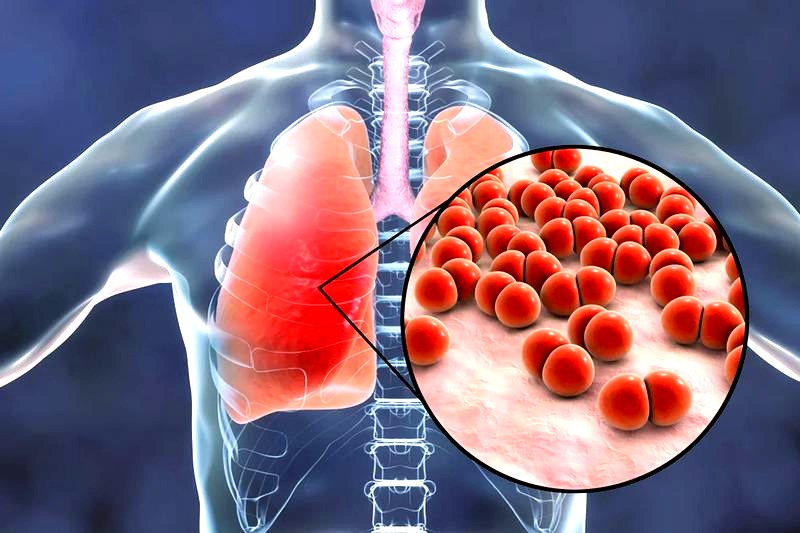 Skuteczne metody leczenia zapalenia płuc u dzieci – co warto wiedzieć?