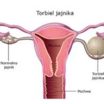Torbiel jajnika – objawy mogące przypominać ciążę
